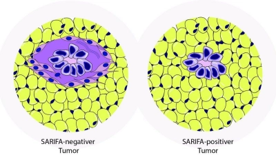 Bei SARIFA-negativen Tumoren (links) werden die Krebszellen (blau) durch Bindegewebszellen (lila) abgekapselt. Bei SARIFA-positiven Tumoren (rechts) unterbleibt das - sie kommen in direkten Kontakt zu Fettzellen (gelb). (Foto: Universität Augsburg)